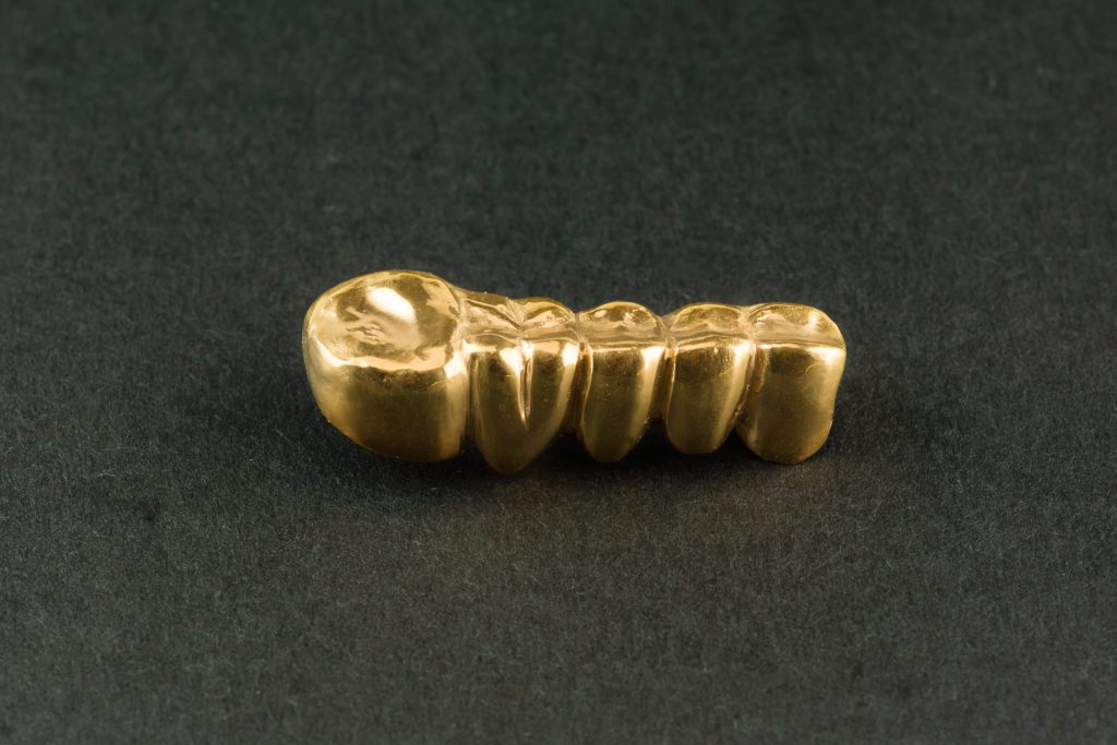 Dentists and Yellow Gold Crowns